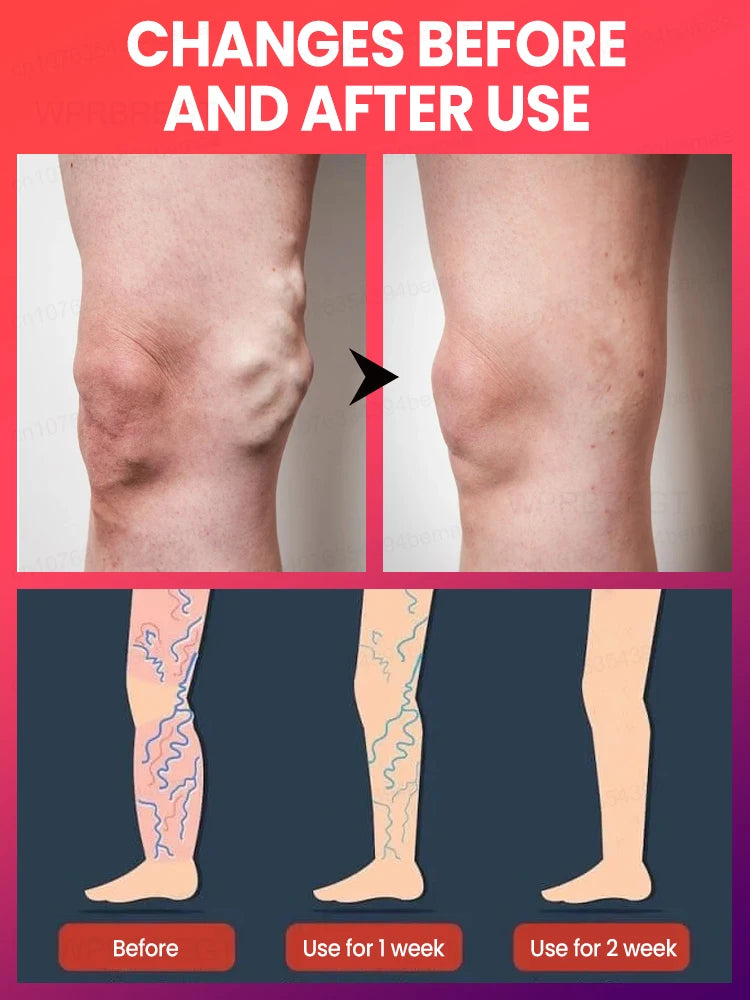 blue light pen solve varicose veins, hot sale leg care tools