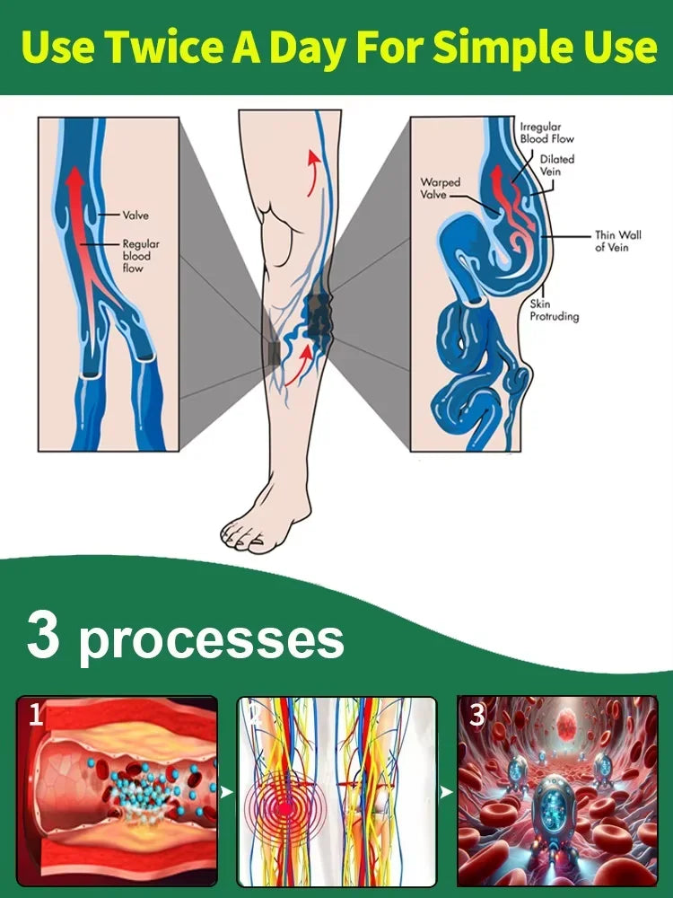 blue light pen solve varicose veins, hot sale leg care tools